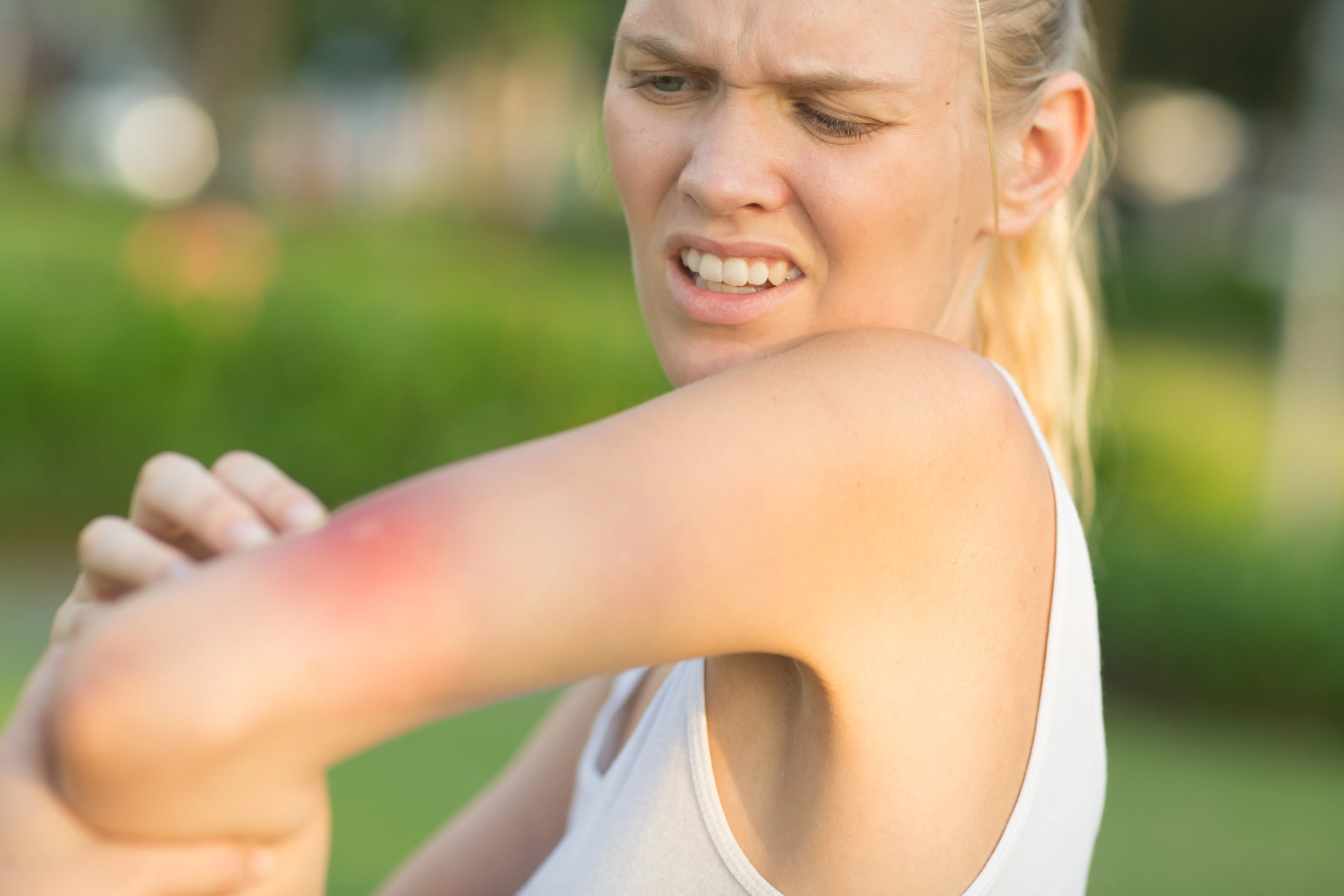 A sting in the tail: when bee and wasp reactions turn serious