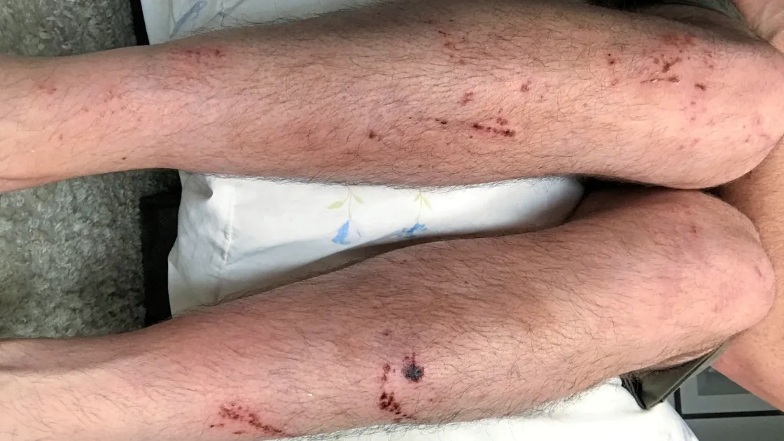Injuries suffered by Oliver Brock while trying to paddle from Lihou to Guernsey with his son. (22148115)