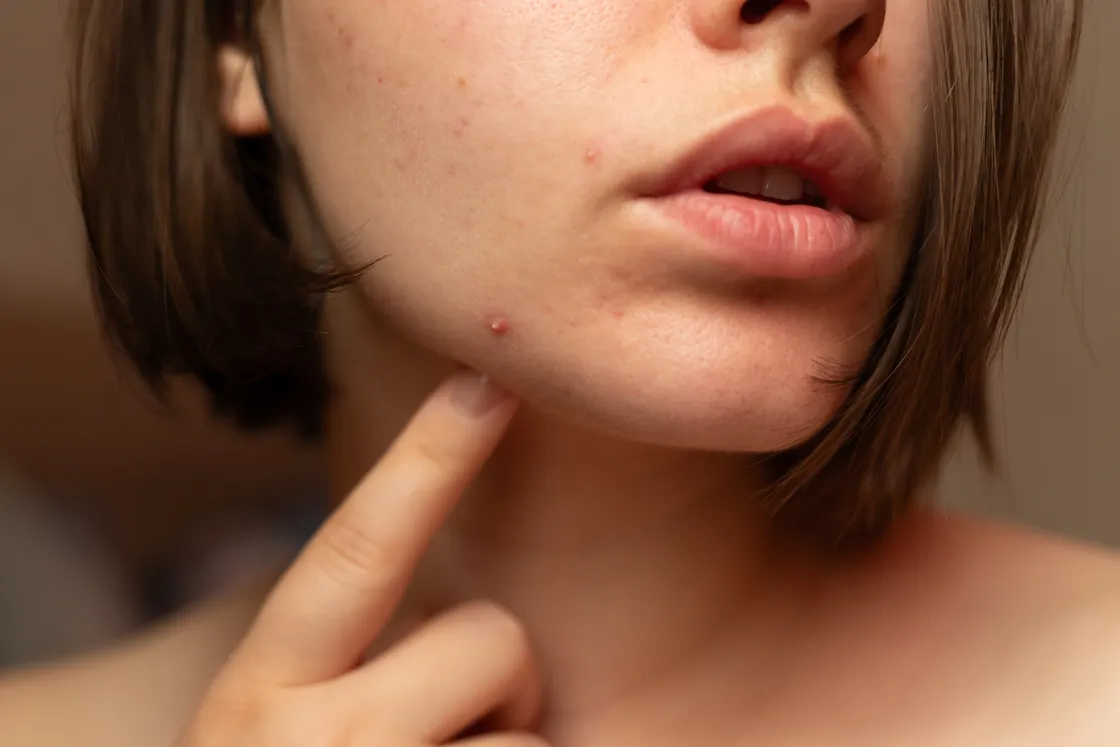 Symptoms may include excess facial or body hair, persistent or severe acne and thinning hair on the scalp.